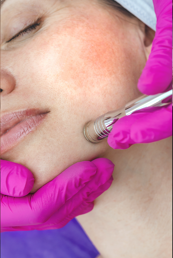 Microdermabrasion